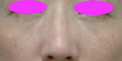 WPRPF lowerlid after-thumb-500x250-1321.jpgのサムネール画像